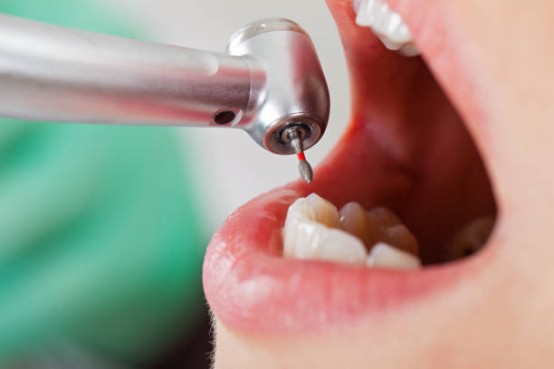 Best Emergency Dental Care for Broken or Chipped Teeth in Libertyvle, IL